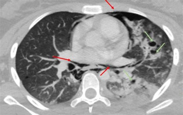 What does pneumomediastinum feel like?